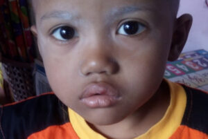 Kanker Darah