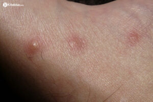 5 Gejala Kanker Kulit Serta Perjuangan Pak Yanto untuk Sembuh