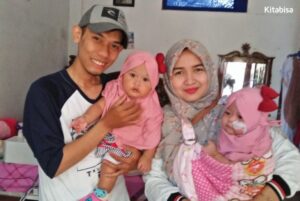 Cerita Bayi Kembar Sembuh dari Penyakit Jantung Bocor