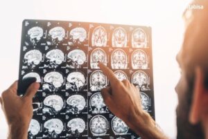 tumor otak adalah