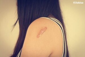 keloid adalah