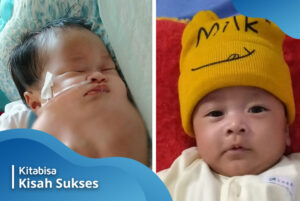 Tumor pada Bayi Gibran berhasil diangkat
