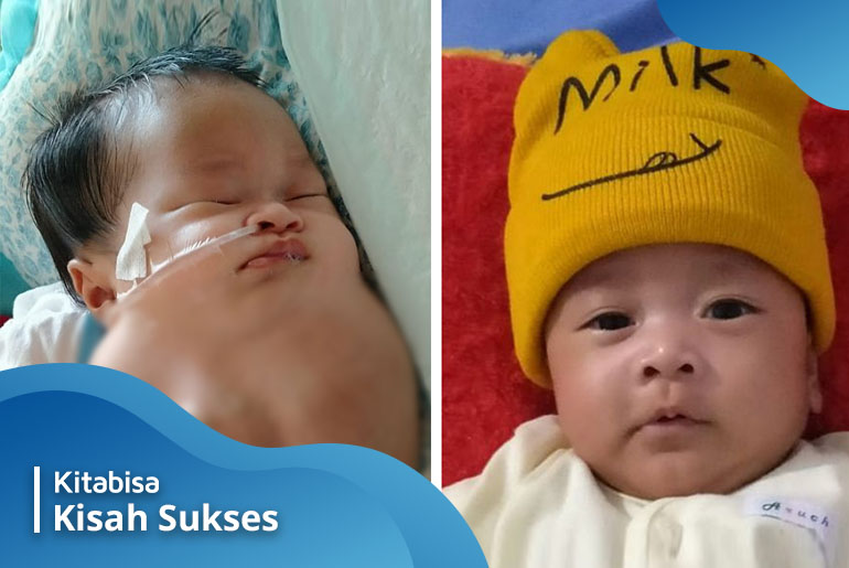 Tumor pada Bayi Gibran berhasil diangkat