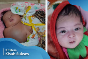Bayi Aqila Sembuh dari Tumor Leher