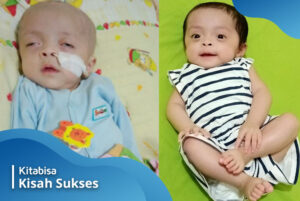 Bayi Fachira Pulih dari Kelainan Paru-Paru